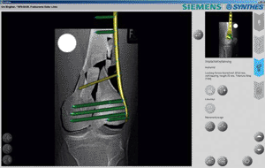 Image: Virtual planning with the PreOPlan software solution (Photo courtesy of Siemens Healthcare).